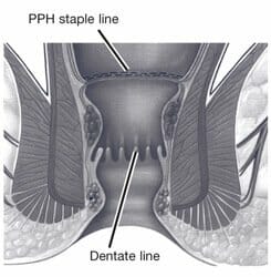 Fig. 4. PPH, completed Fig. 4. PPH, completed