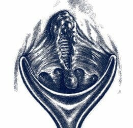 Chronic posterior anal fissure