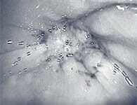 flat polyp with a central depression