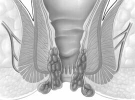 Internal and external hemorrhoids Internal and external hemorrhoids
