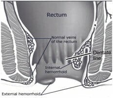 Hemorrhoidal anatomy Hemorrhoidal anatomy