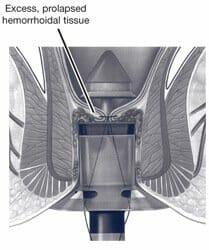 Fig. 3. PPH, excess tissue removal Fig. 3. PPH, excess tissue removal
