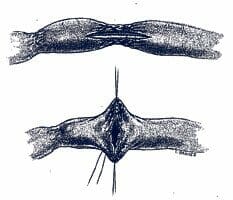 Stricturoplasty Stricturoplasty