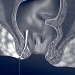 The Surgisis® plug. The Surgisis® plug.