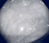 flat polyp seen with white light