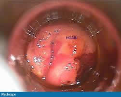 AIN 3 Stained with Logol's Solution AIN 3 Stained with Logol's Solution