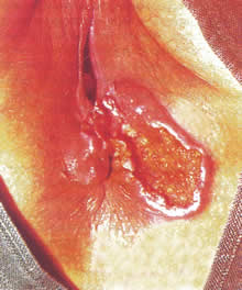 Squamous Cell Carcinoma Squamous Cell Carcinoma