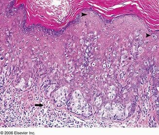 The pathology of Paget’s disease The pathology of Paget’s disease