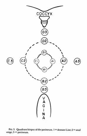 Biopsy sites for Paget’s disease treatment Biopsy sites for Paget’s disease treatment