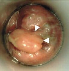 Polypoid anal melanoma
