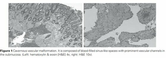 F1-Cavernous vascular malformation Cavernous vascular malformation
