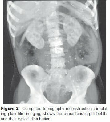 Computed tomography reconstruction