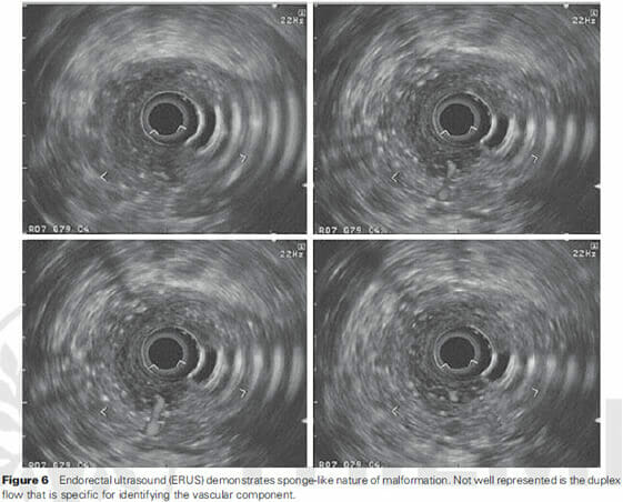 F6-Endorectal ultrasound Endorectal ultrasound
