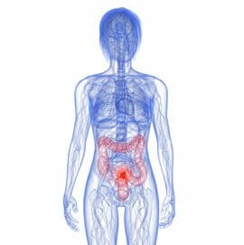 To screen for colon cancer in Culver City or Beverly Hills, be prepared for your colonoscopy