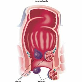 Identifying Hemorrhoids in Los Angeles: External or Internal?