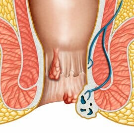 THD - A New Approach to Hemorrhoid Treatment THD - A New Approach to Hemorrhoid Treatment
