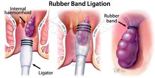 Hemorrhoids. Rubber Band Ligation. Los Angeles.