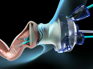 Transanal Minimally Invasive Surgery