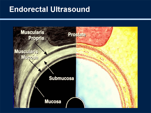 Endorectal Ultrasound Peering into the Sunless Vault