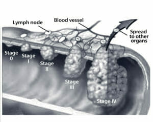 UNLOCKING THE DILEMMA OF RECTAL CANCER