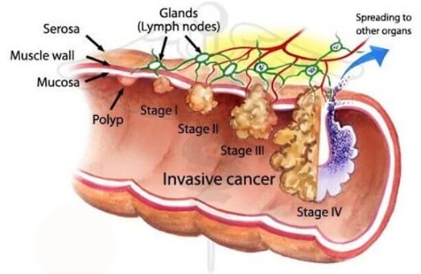 Graphic about the different stages of anal cancer