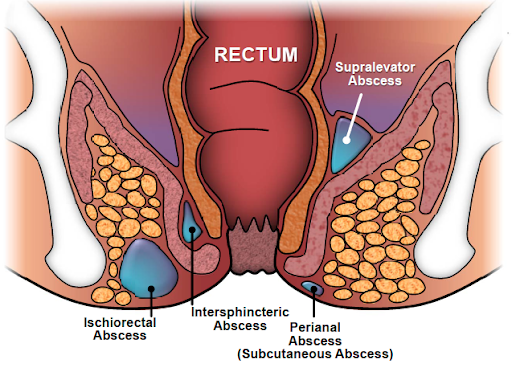 Types of anal abscesses