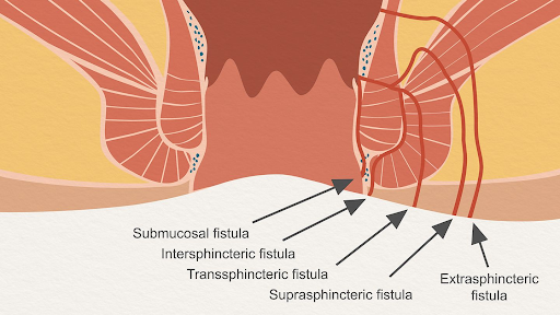 Getting Surgery for a Perianal Fistula