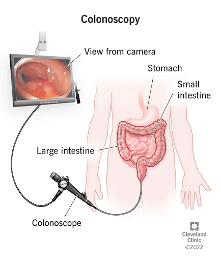 Diagram of what occurs during a colonoscopy